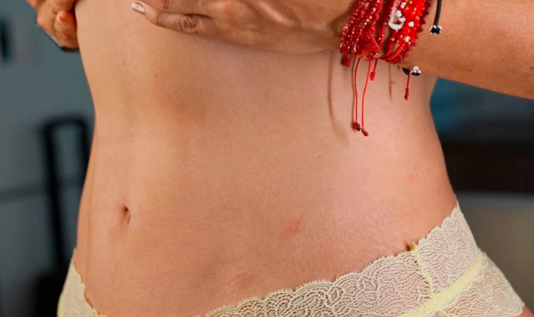 Resultado Lipoescultura